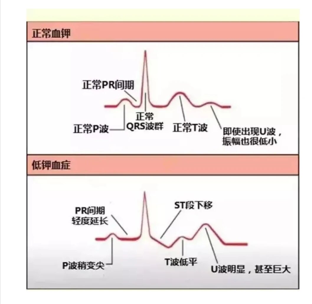 低血钾心电图表现口诀图片