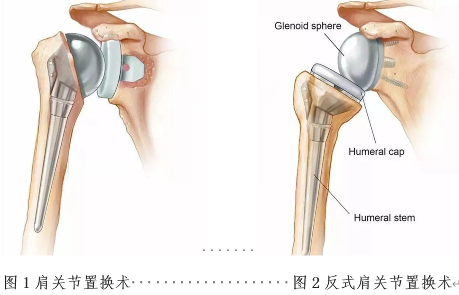 巨大不可修复肩袖损伤患者福音反肩关节置换术