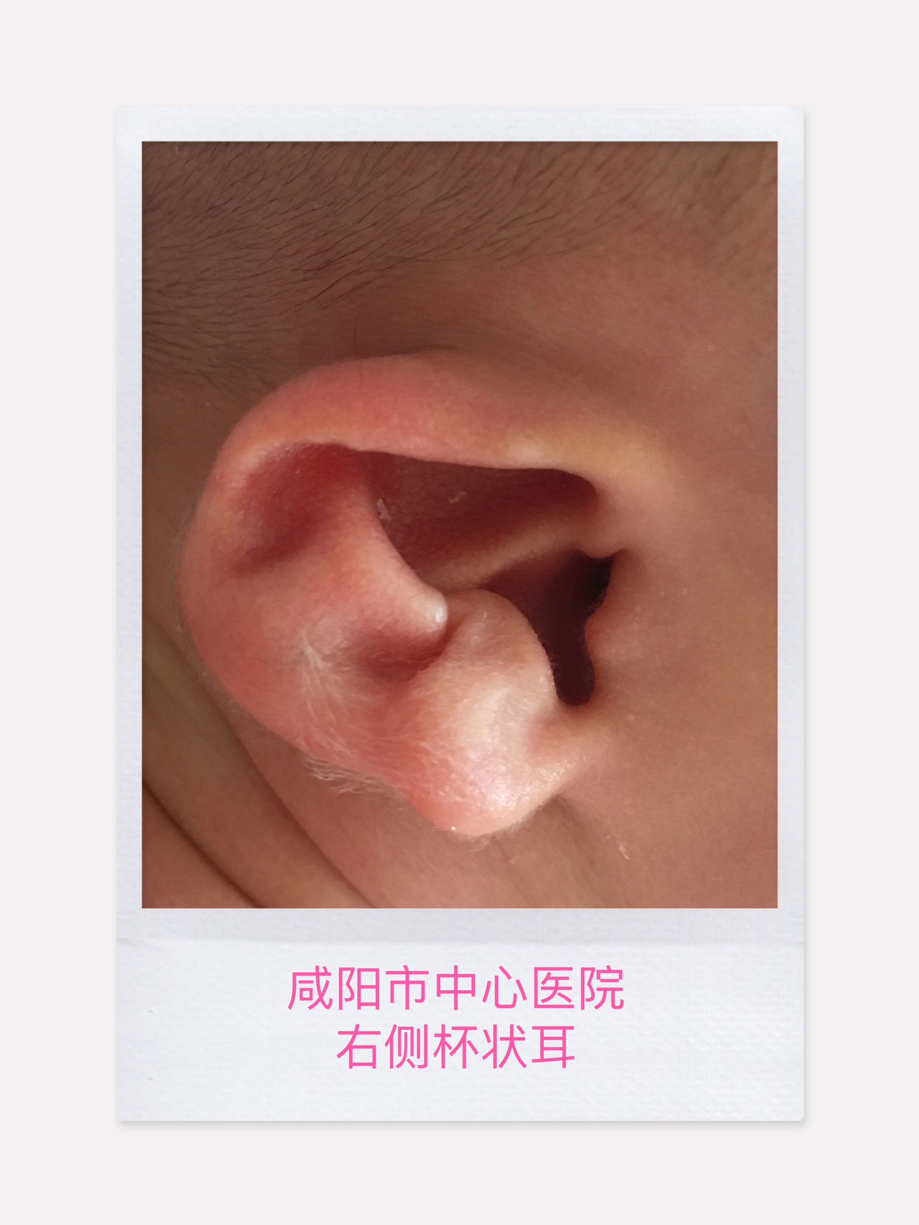 二是结构畸形:即胚胎发育早期耳部皮肤及软骨发育不全导致的外耳畸形