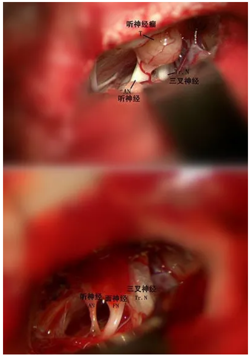 听神经瘤_介绍_症状表现_治疗方式 - 好大夫在线