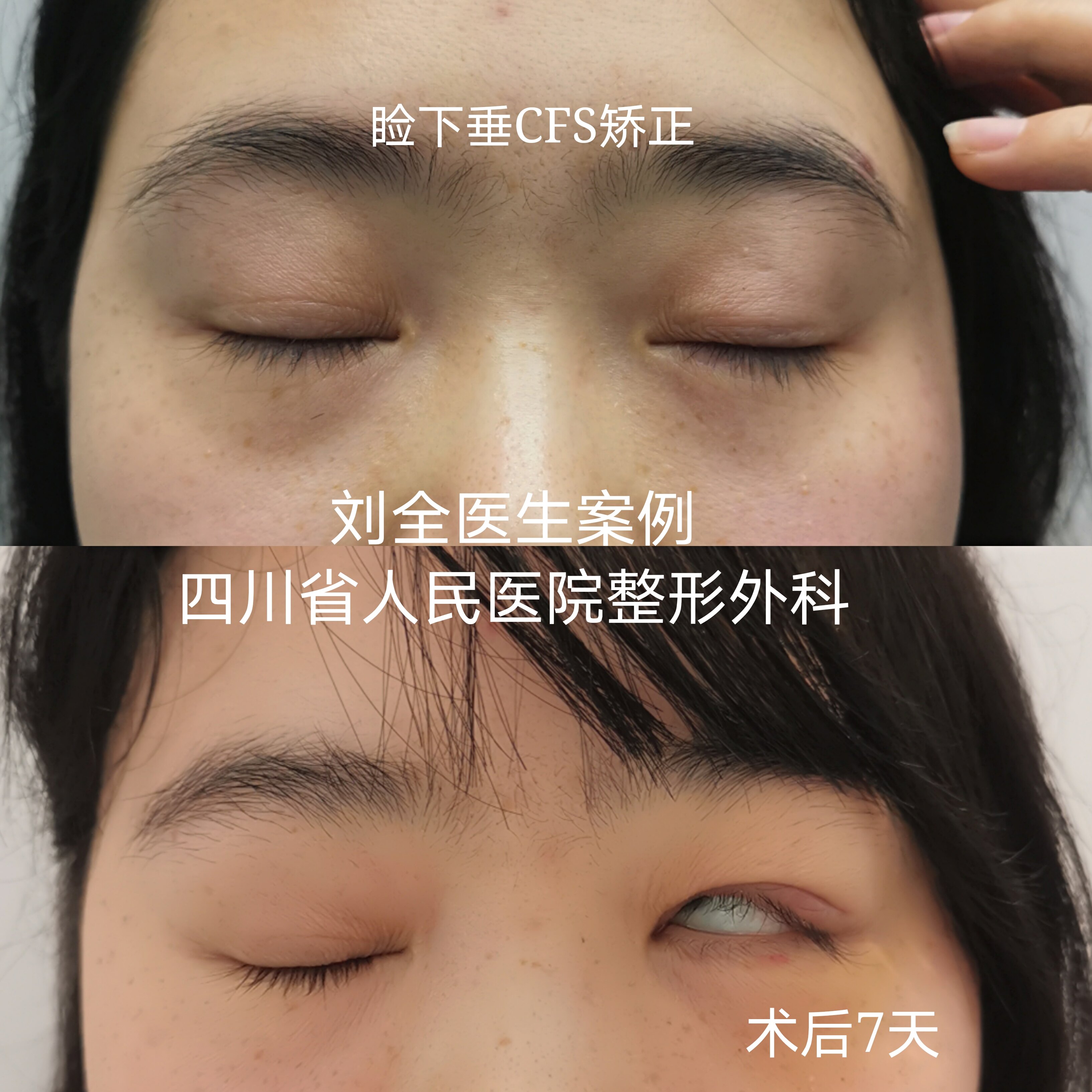 cfs～上睑下垂,用案例说话 - 好大夫在线