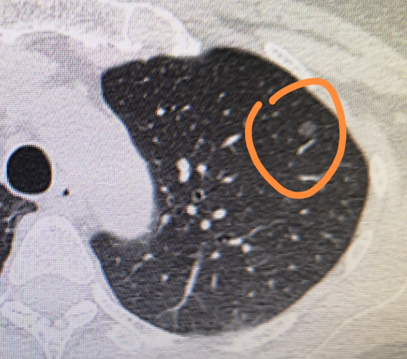 同样是左上肺小结节,为什么我太太只需要定期观察,而我的却需要手术