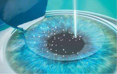 现在主流的激光近视手术方式有几种?