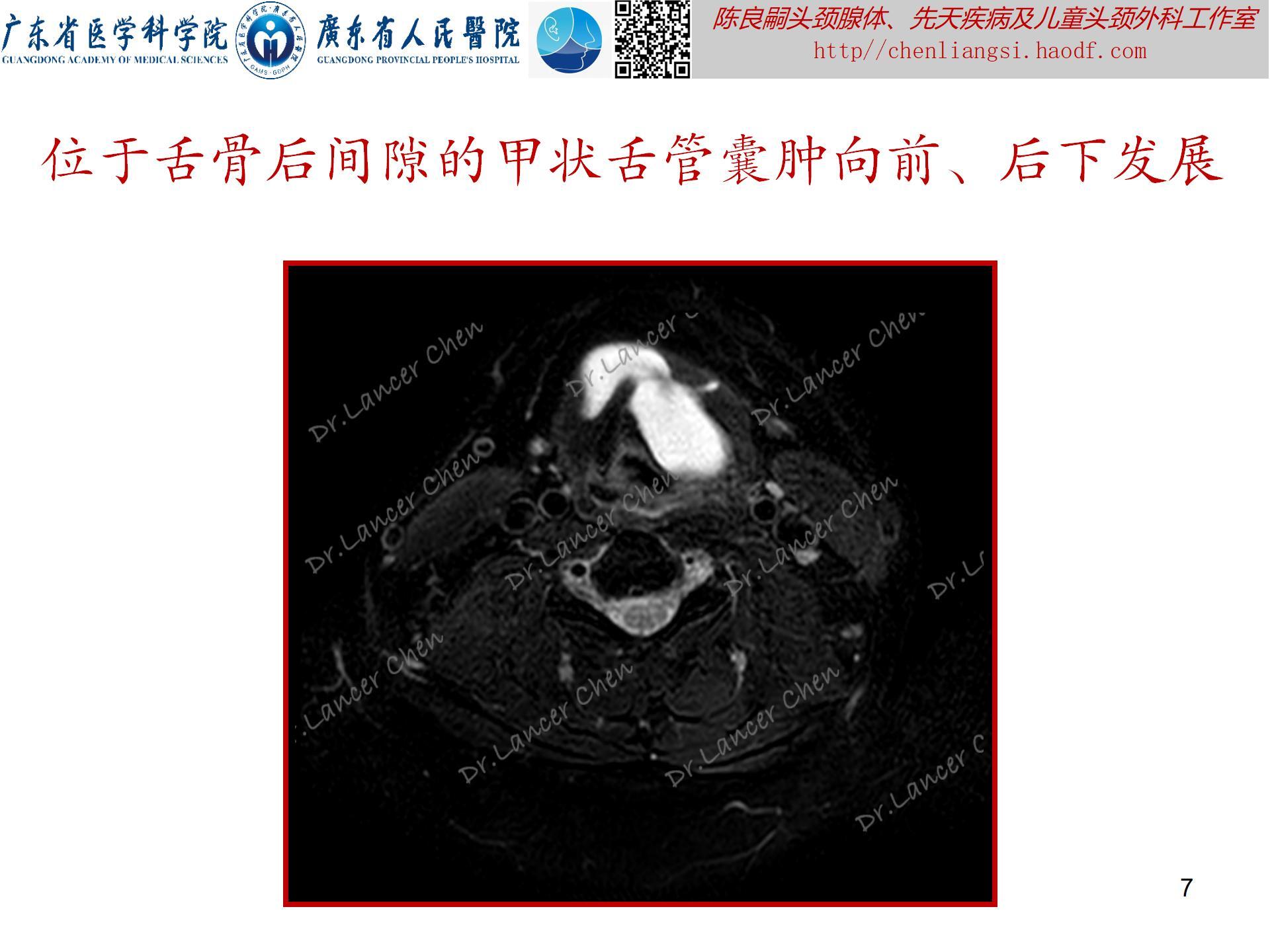 20240621：医学科普——百密一疏：舌骨后间隙的忽略，可导致甲状舌管囊肿术后复发_07.jpg