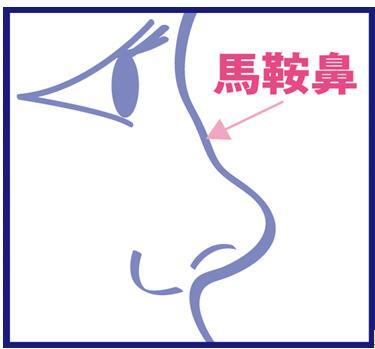 单纯性鞍鼻:表现为鼻梁平坦或凹陷,鼻尖支撑尚可或鼻尖圆钝低平,鼻腔