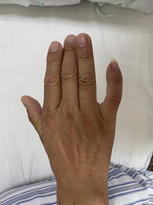 手麻肌萎缩2----肘管综合征的诊断与治疗_肘管综合征_发病原因_症状