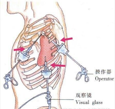 三孔示意图.jpeg