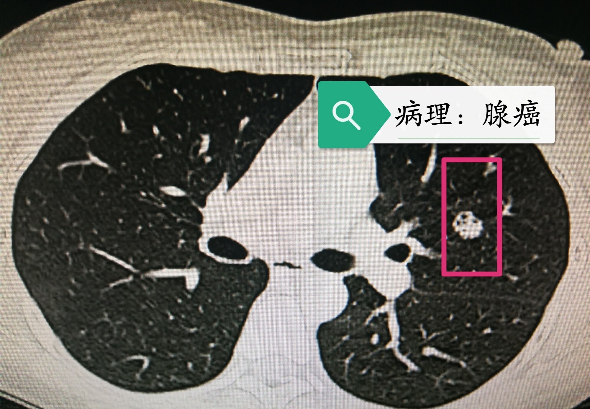 肺結節真面目1如何根據ct來初步判斷良惡性