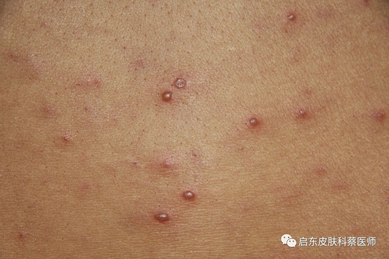 水痘 水痘 水痘 水痘 水痘 水痘