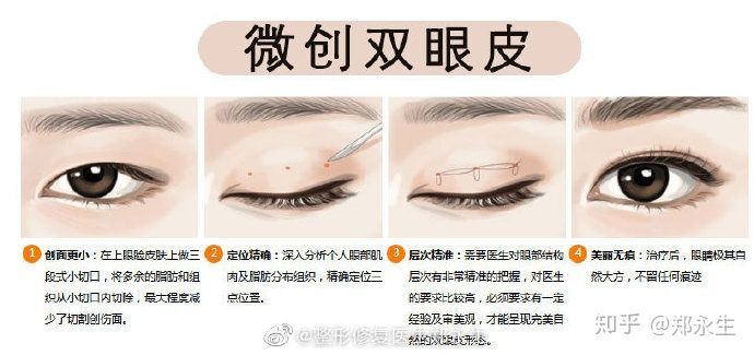 有几种方法!_双眼皮手术 - 好大夫在线
