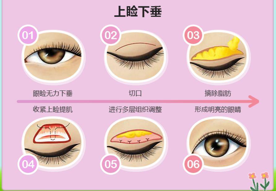 上睑下垂_上睑下垂治疗方式 - 好大夫在线