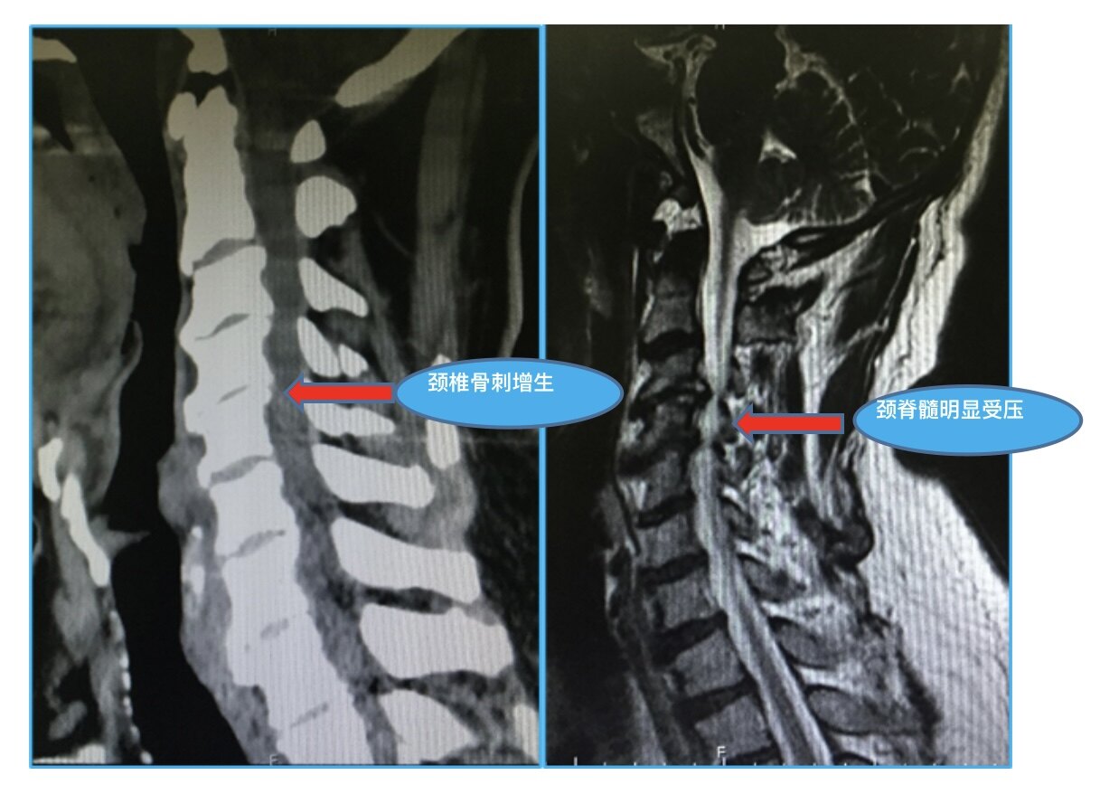 食管压迫型颈椎病图片图片