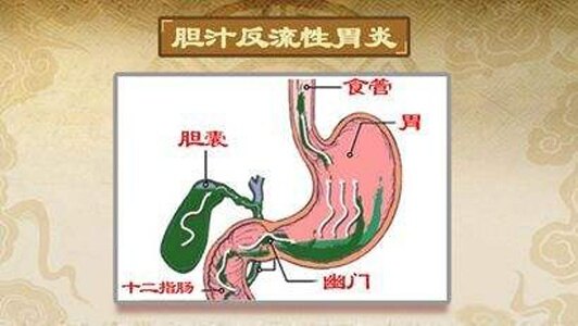 胆汁反流的原因图片