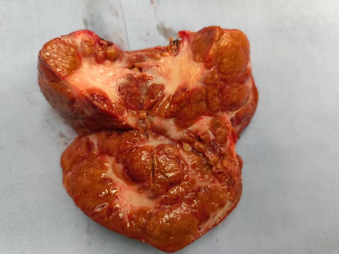 能不能微创治疗?_肝肿瘤_介绍_发病原因_治疗方式 - 好大夫在线