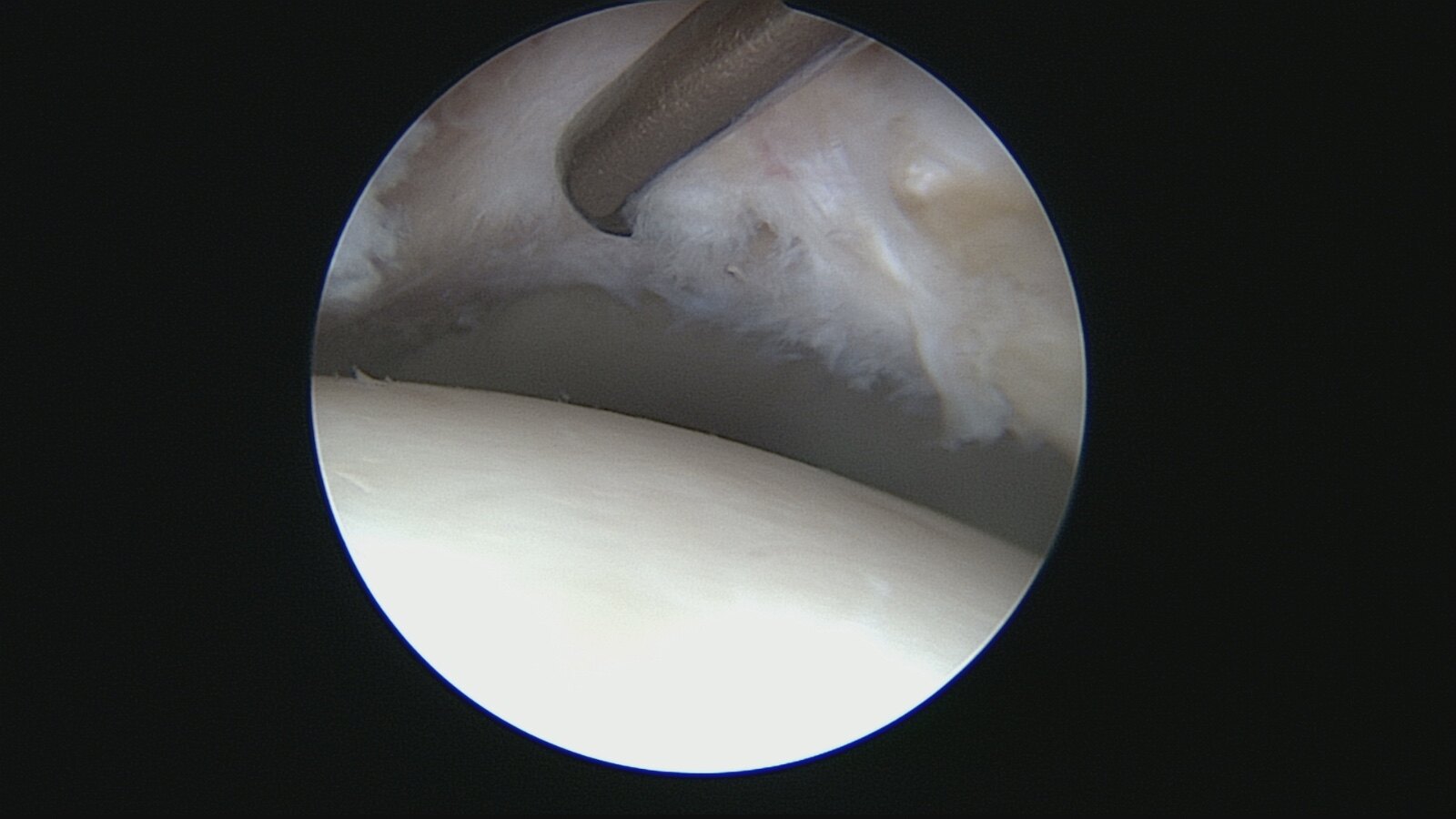 关节镜_关节镜介绍 - 好大夫在线