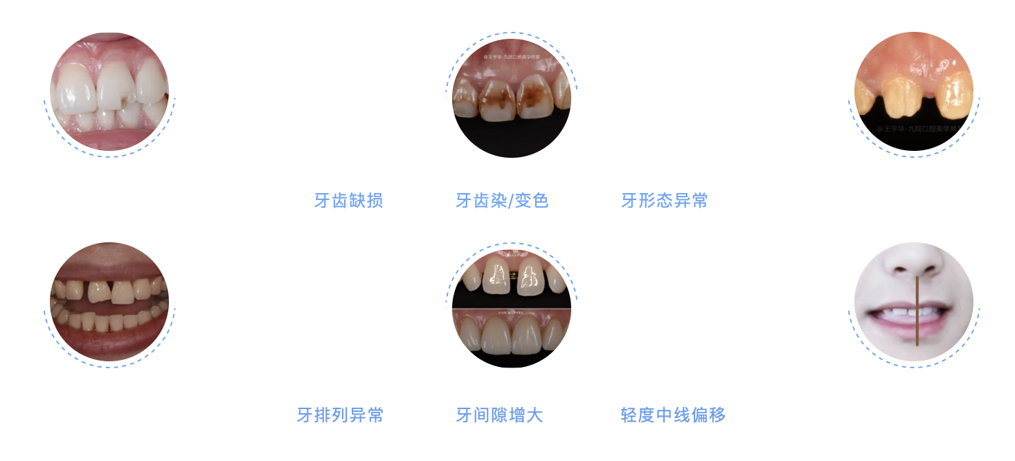 史上最全核心专业介绍，一文了解贴面有哪些材料价格如何你应该怎么选_牙齿美白_治疗介绍_费用- 好大夫在线