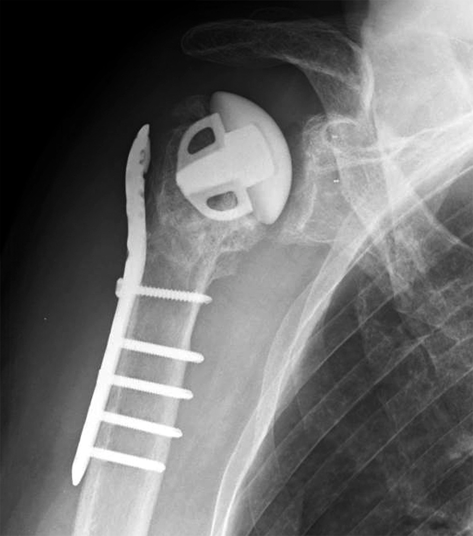 肱骨头缺血性坏死:病因,诊断和治疗_股骨头坏死_介绍_发病原因_检查