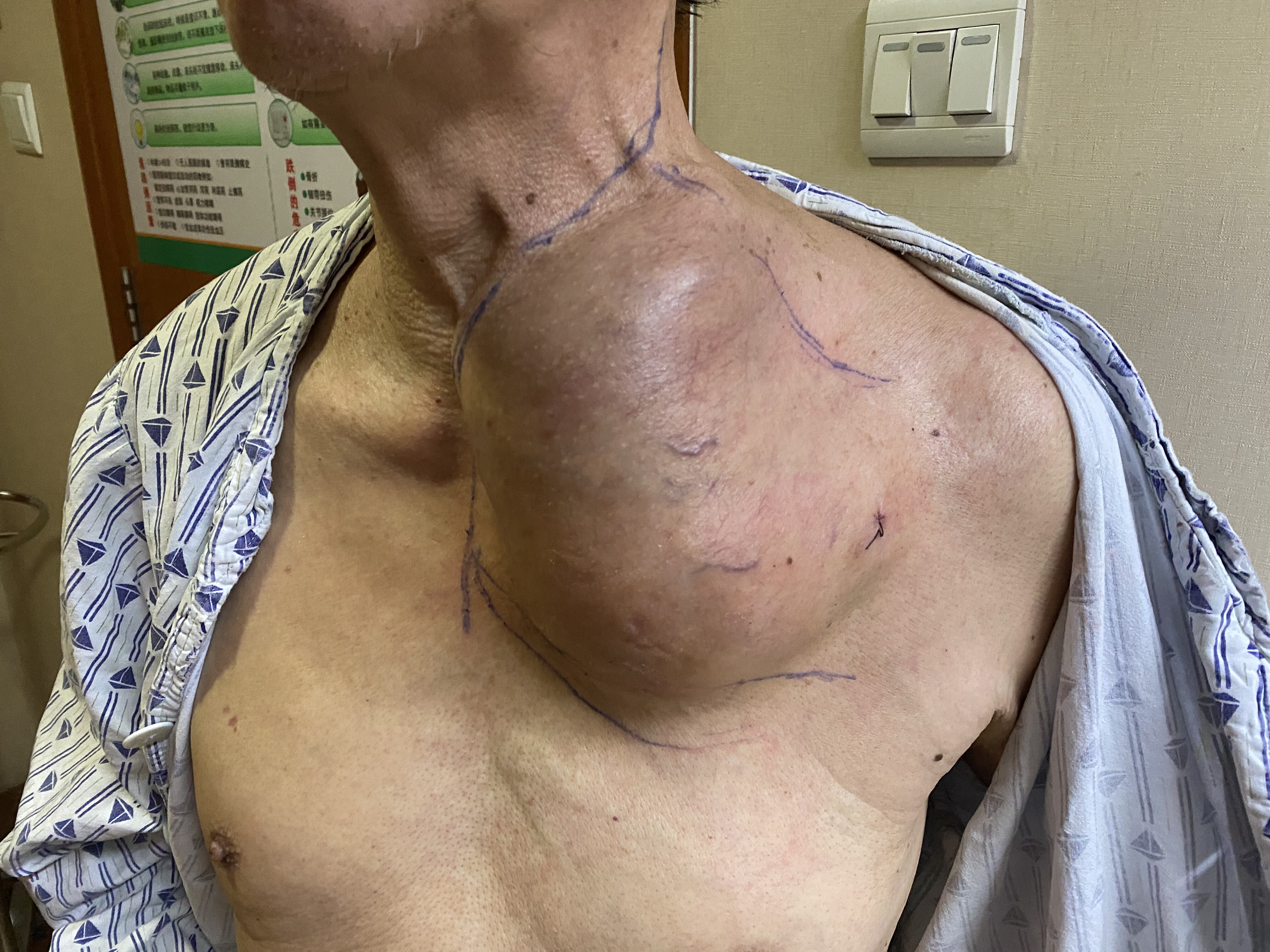 胸壁巨大恶性肿瘤的外科手术切除 