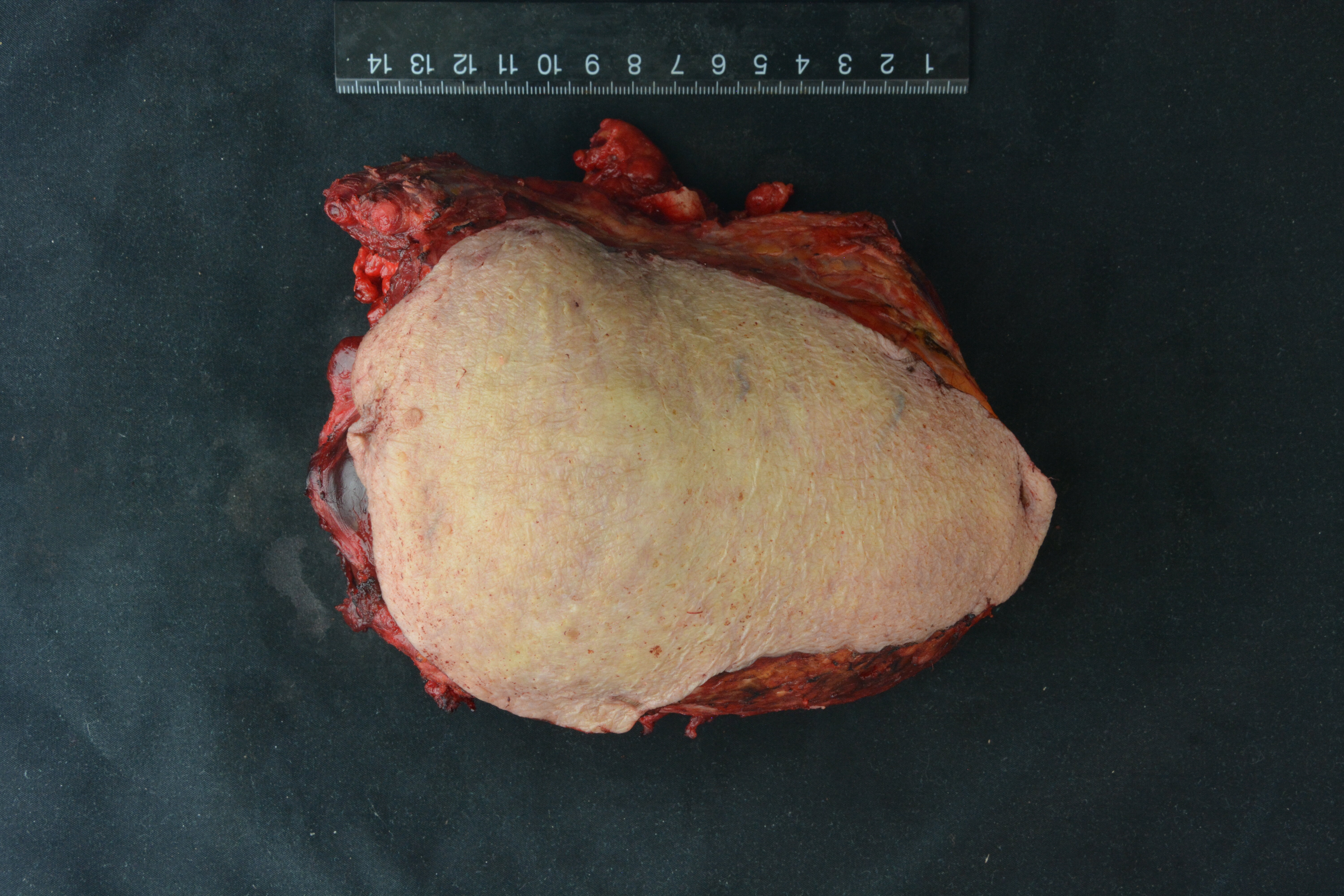 胸壁皮下肿瘤图片
