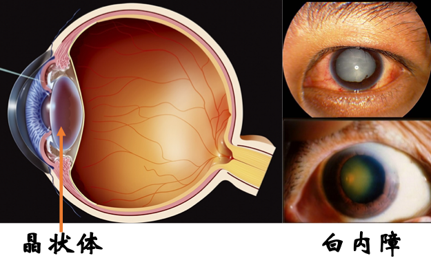 白内障是什么样子图片图片