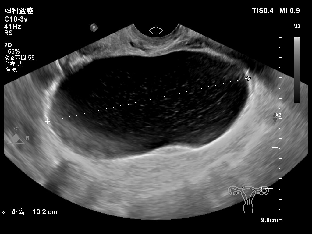 25岁,8个月前因左侧卵巢浆液性囊腺瘤于我院行腹腔镜下左侧 卵巢囊肿
