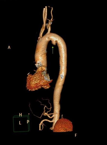 首例胸主动脉瘤合并颈动脉狭窄成功同期开展手术 - 好大夫在线
