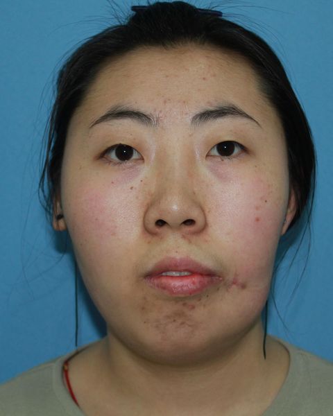 半侧颜面萎缩面部脂肪填充