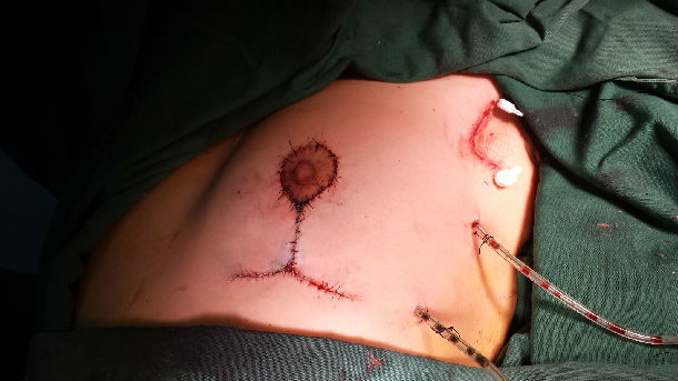 乳房下垂手术 缩小图片