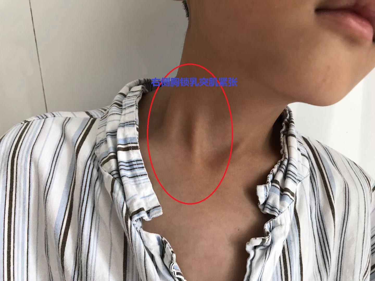 安徽歪脖子斜颈患者在徐州二院骨科找高绪仁关节镜微创手术的经验分享
