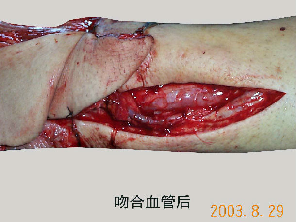 游离胸脐皮瓣01