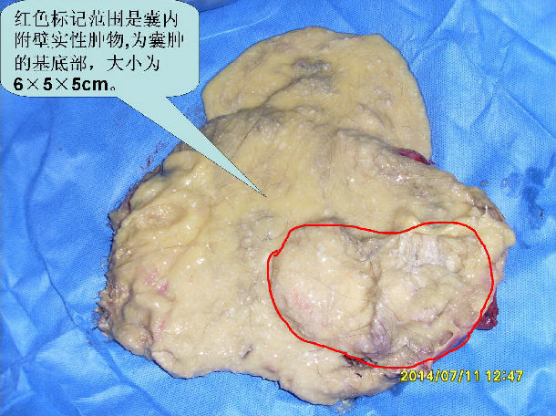 子宮肌瘤和卵巢畸胎瘤乳腺癌保乳手術2年後肺部結節.