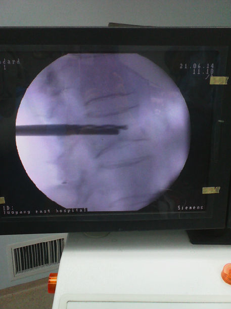 經皮穿刺l1椎體壓縮性骨折骨水泥椎體成形術手術圖片展示