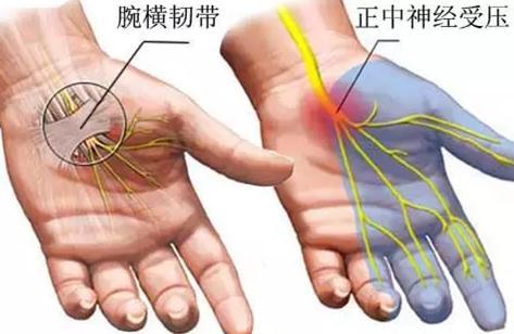 裡面走行著正中神經和多根屈曲手指的肌腱,由於這個管性通道的容積