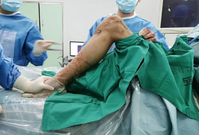 膝关节强直——手术结束只是完成了不到一半的工作 