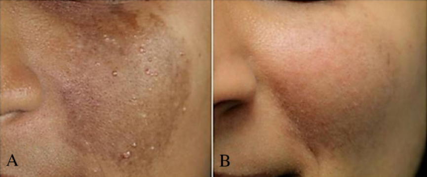 神经纤维瘤科普21:咖啡牛奶斑的激光治疗_咖啡斑_治疗方法_治疗方式