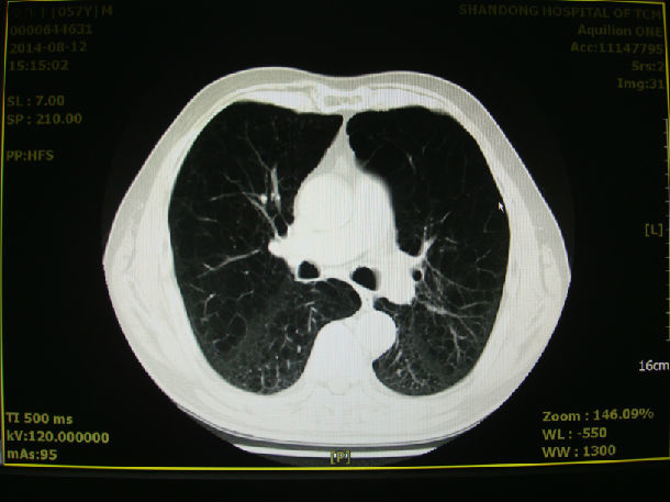 慢性肺炎ct图片