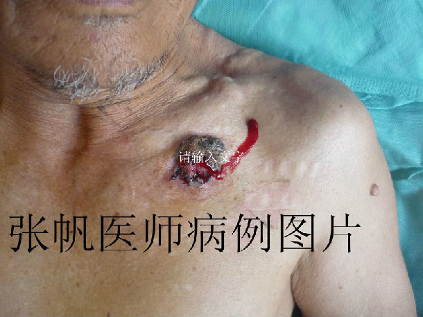 汗孔瘤手术治疗照片