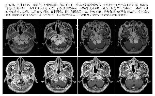 (八)顱底巨大的海綿狀血管瘤顱底海綿狀血管瘤,常常侵犯海綿竇,發展