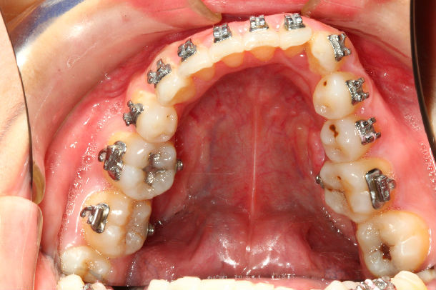 在不正规的诊所矫正一年半之后的结果加力过猛导致上门牙牙根严重吸收