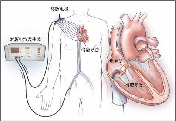 浦南医院 于泓 文章列表>心律失常(8 特殊治疗方法 射频消融治疗