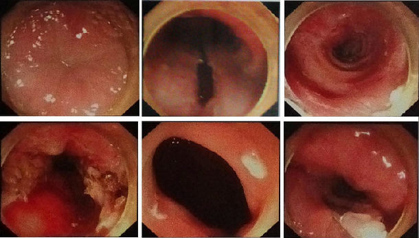 贲门失弛缓症的poem微创手术治疗 - 好大夫在线