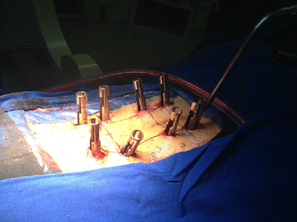 椎弓根螺钉内固定手术图片