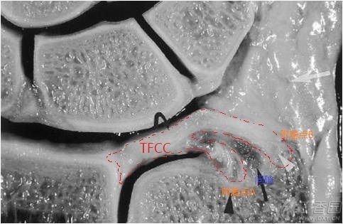 详解tfcc的解剖 - 好大夫在线