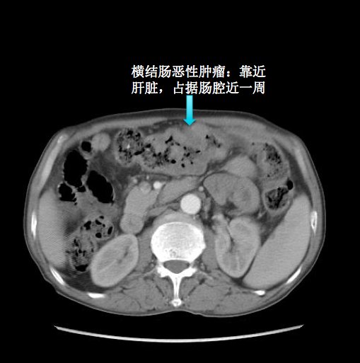 右半結腸癌病例分享橫結腸癌近肝曲