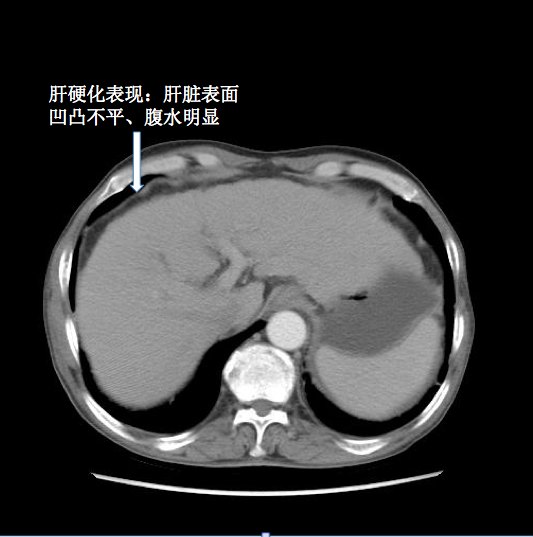 右半結腸癌病例分享橫結腸癌近肝曲