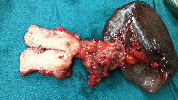 胰体尾癌图片