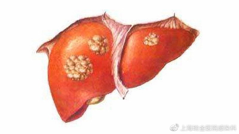 肝脏结节危害大吗,如何尽早发现呢?