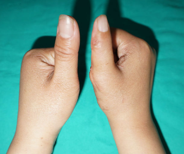 先天性拇指多指畸形(复拇指畸形)的矫正
