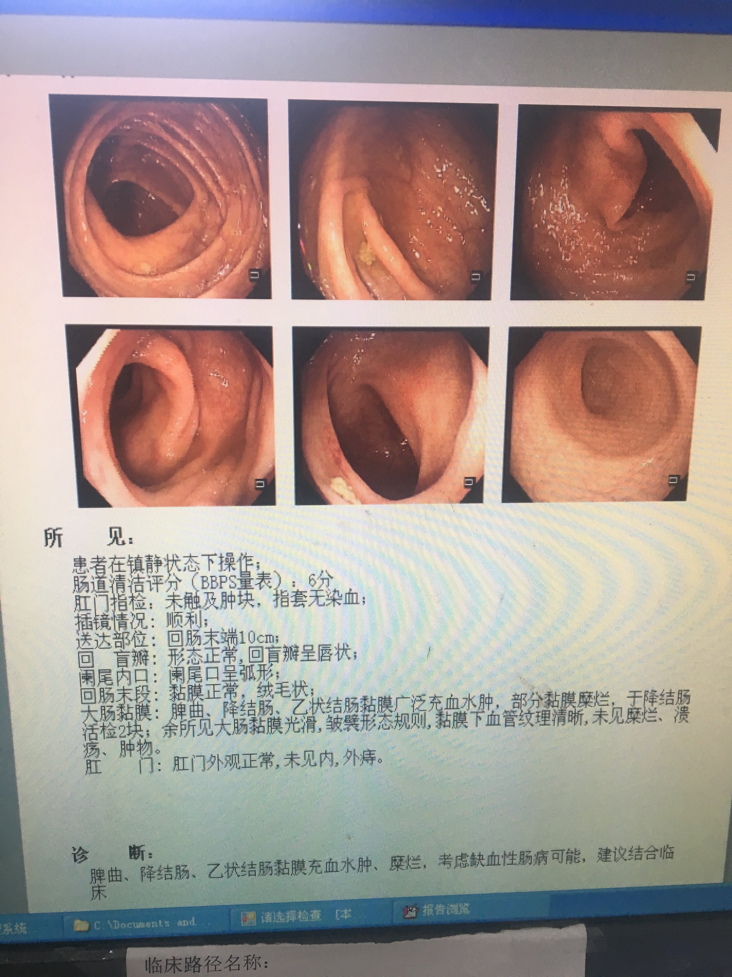 便血誤以為是痔瘡所致醫生慧眼識真相缺血性腸病的症狀與治療