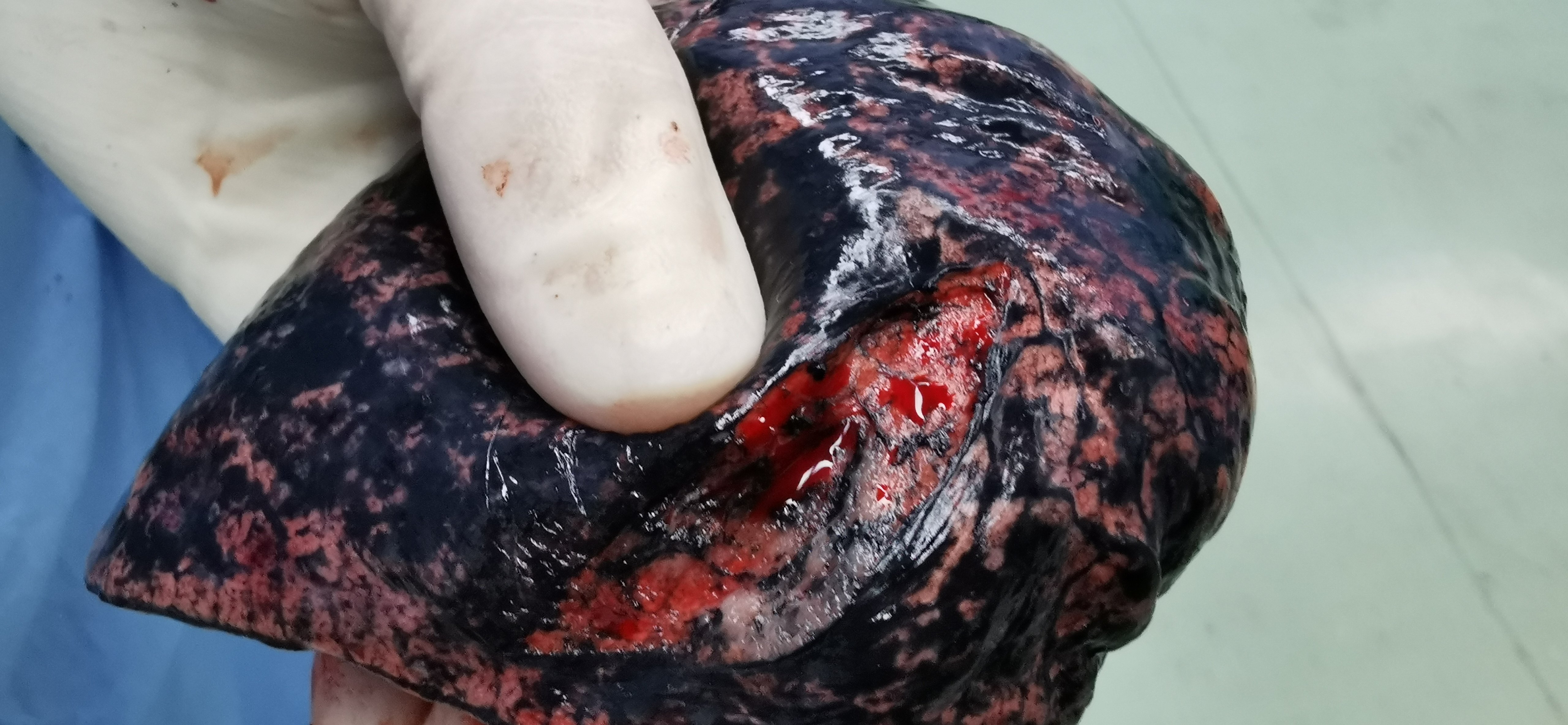 右肺癌术后,左肺磨玻璃结节,腺癌 - 好大夫在线